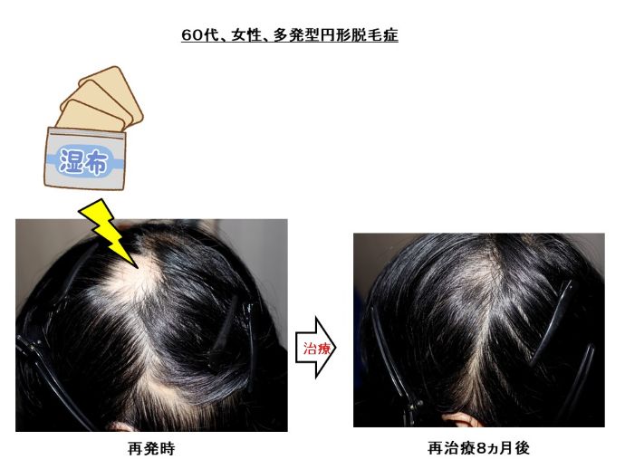 円形脱毛症　病院